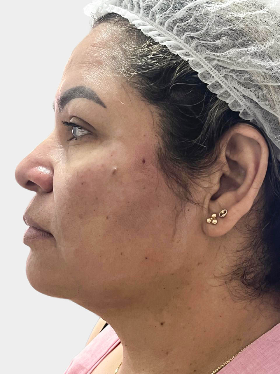 Después de Hilos Tensores