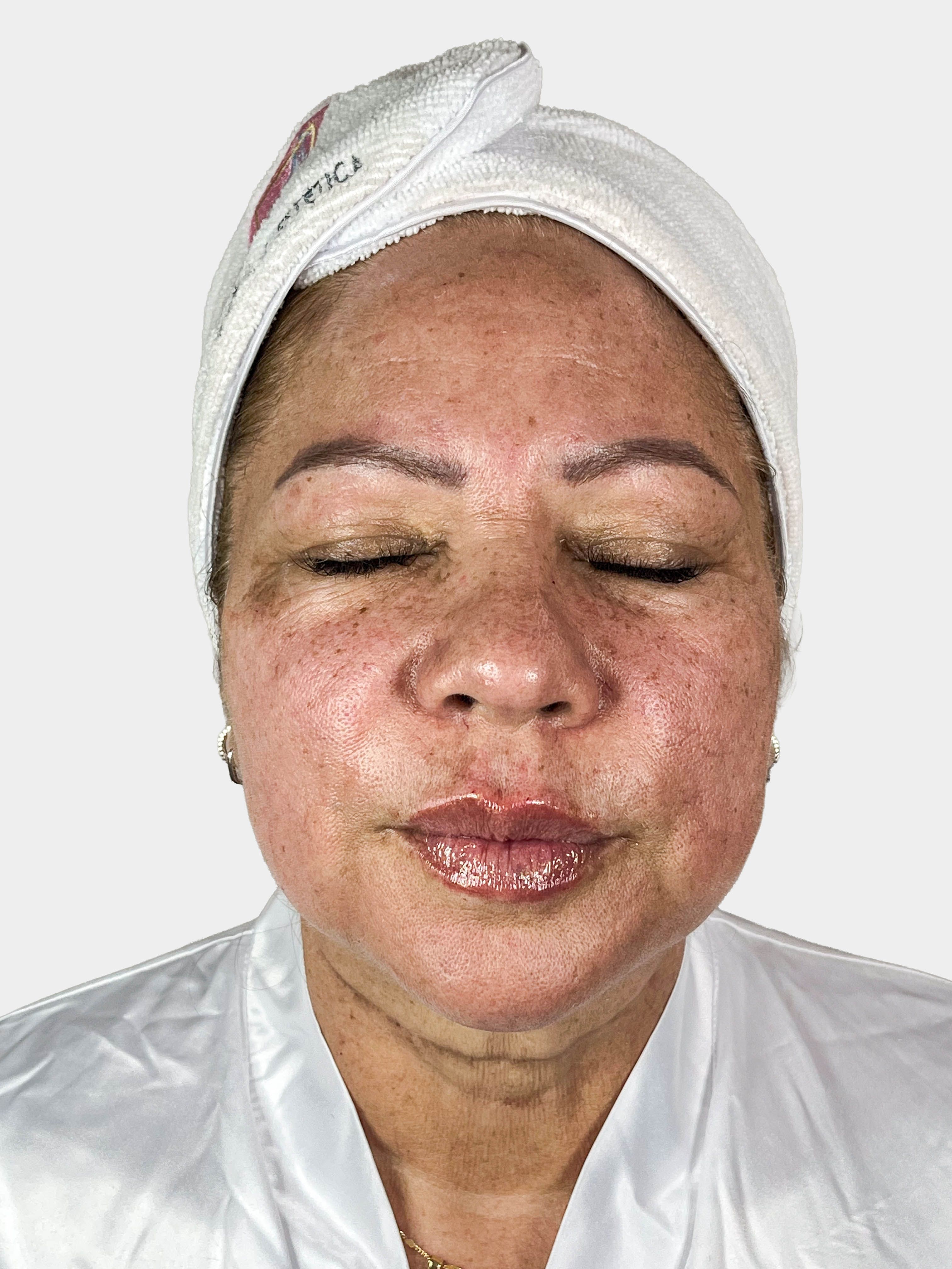 Después de Radiesse