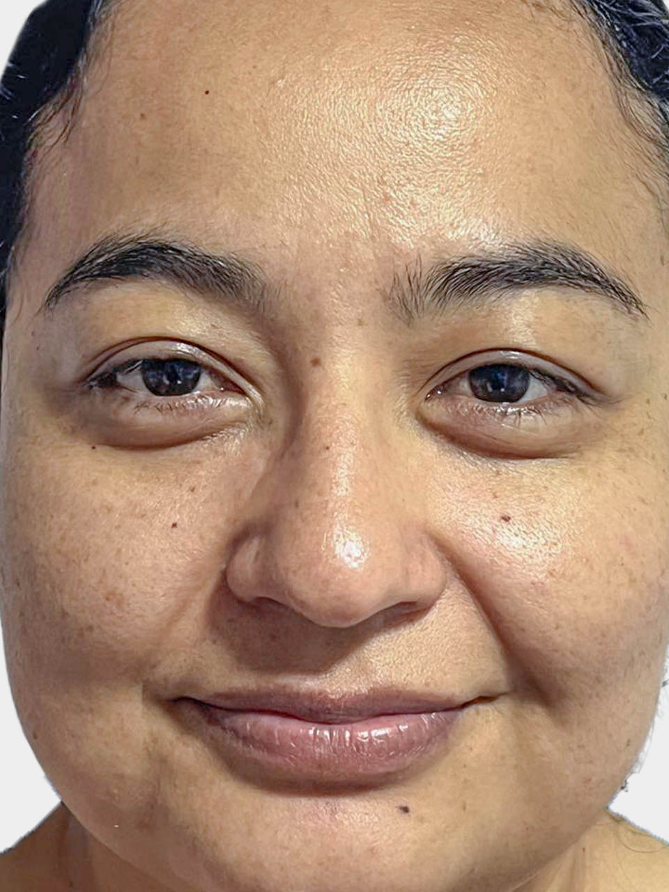 Antes de Rinomodelación