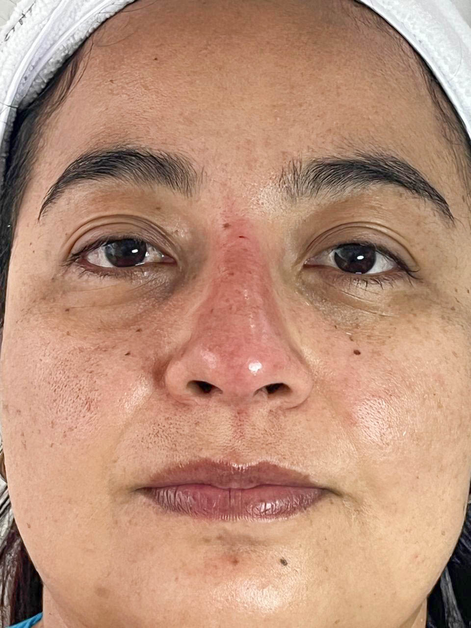 Después de Rinomodelación