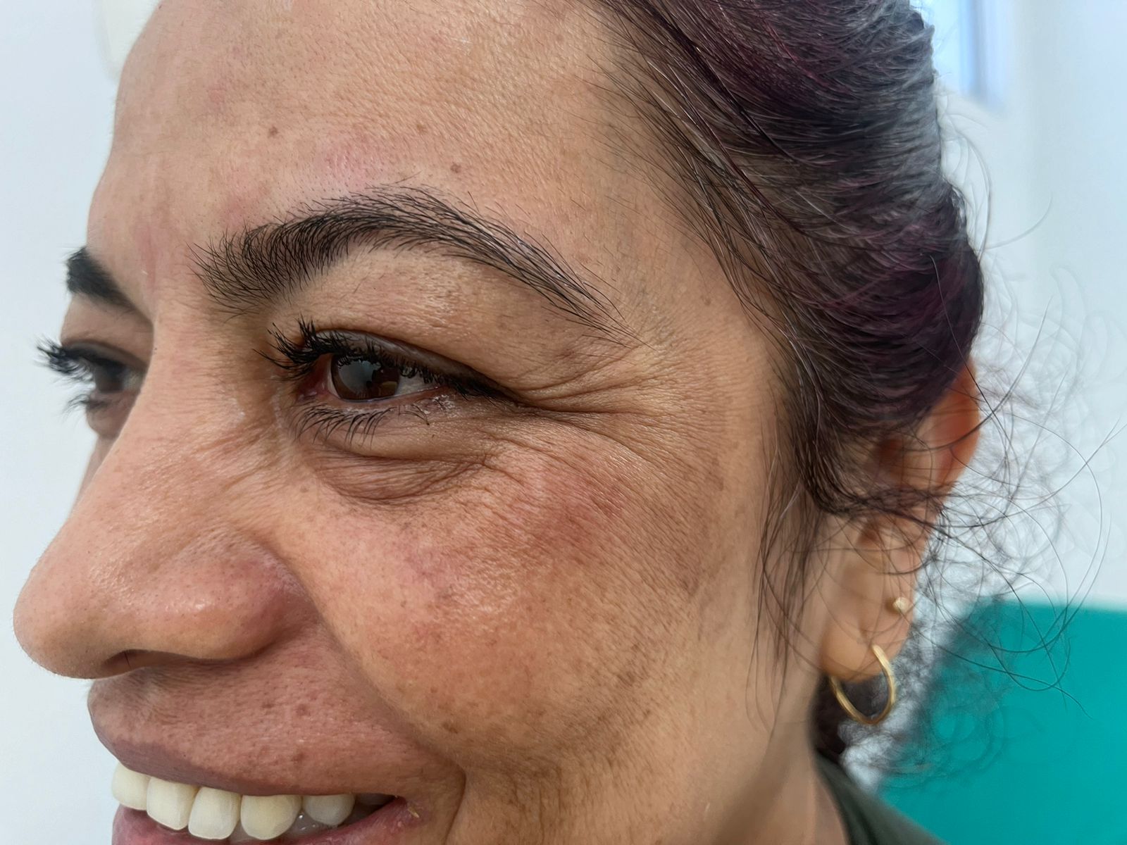 Antes del tratamiento facial