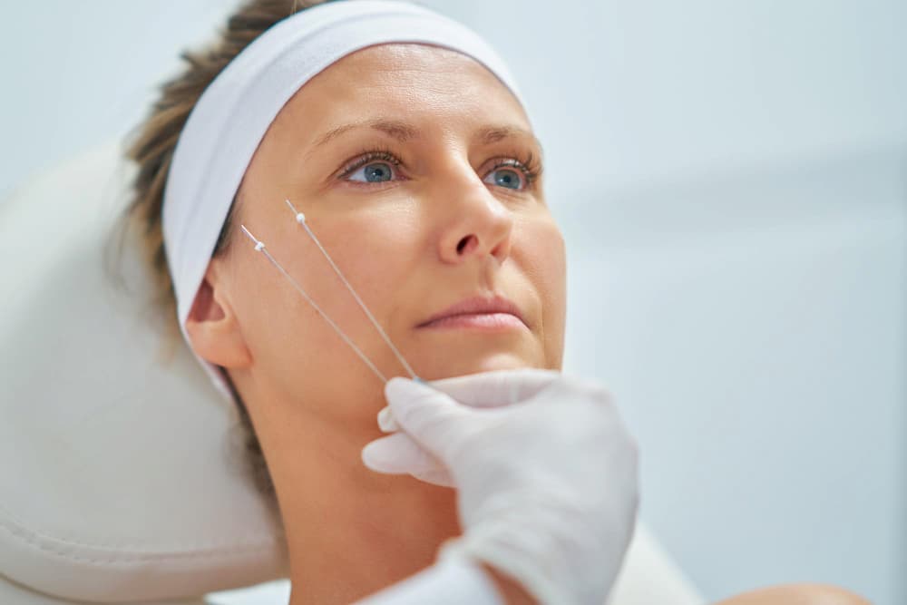 Hilos PDO tensores y bioestimulación